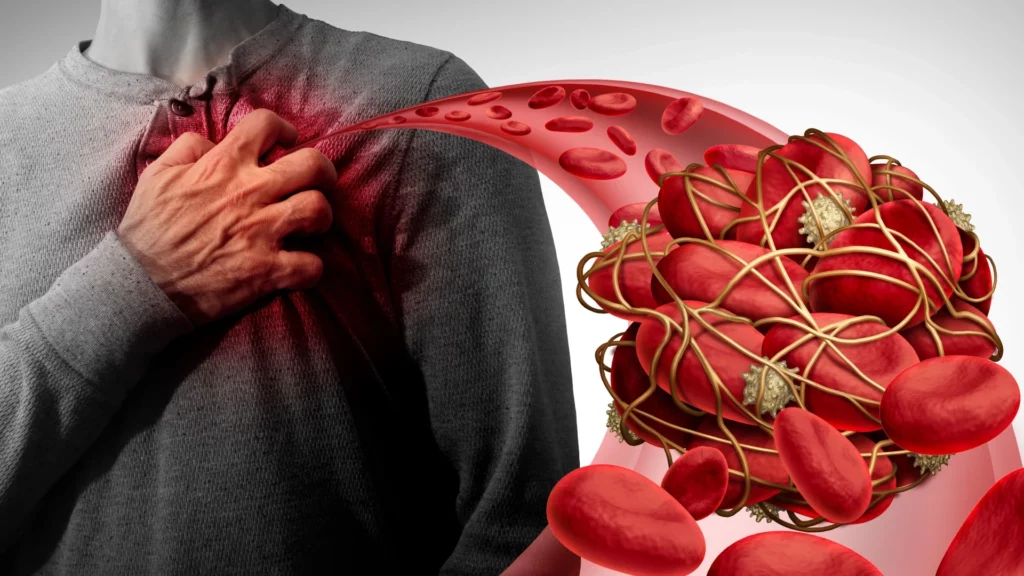 Trombofilia - przyczyny, objawy, leczenie nadkrzepliwości krwi 